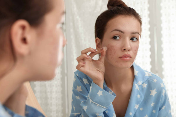 YOUR BEST FOOD CHOICES TO HELP FIGHT TEEN ACNE